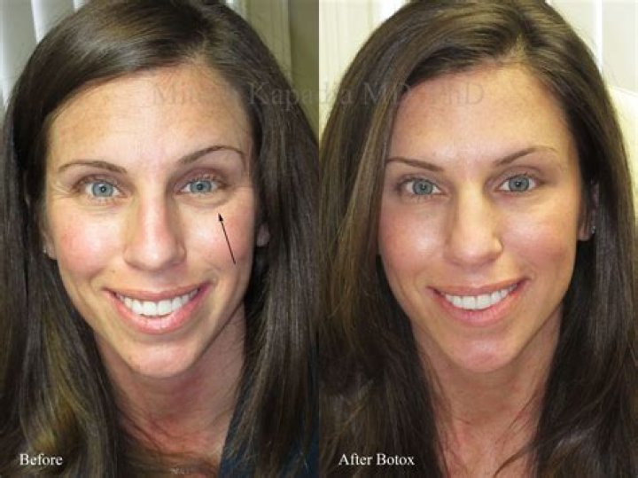 Alyssa Milano Plastic Surgery Before and After Botox Injections