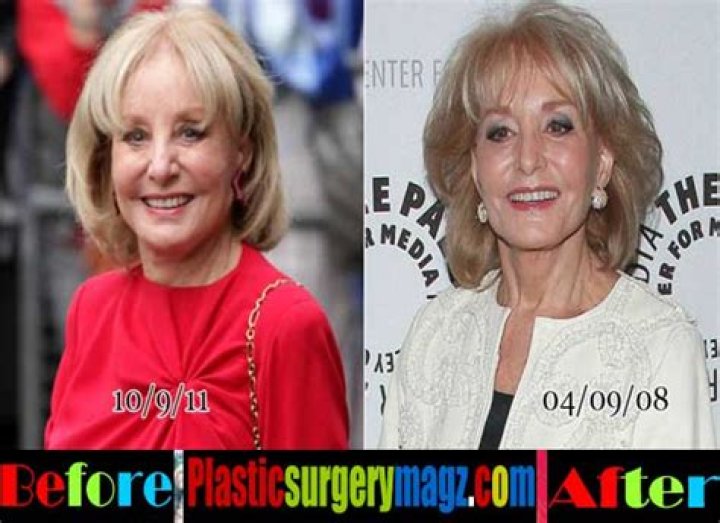 Barbara Walters Facelift Plastic Surgery Before and After