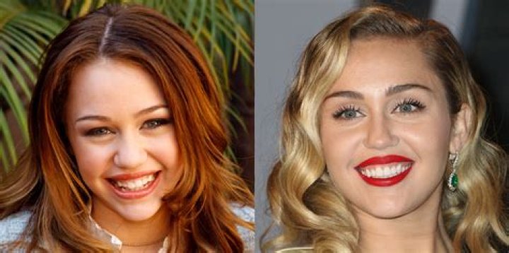 Can You Eat And Drink With Clip In Veneers? – Celebrity
