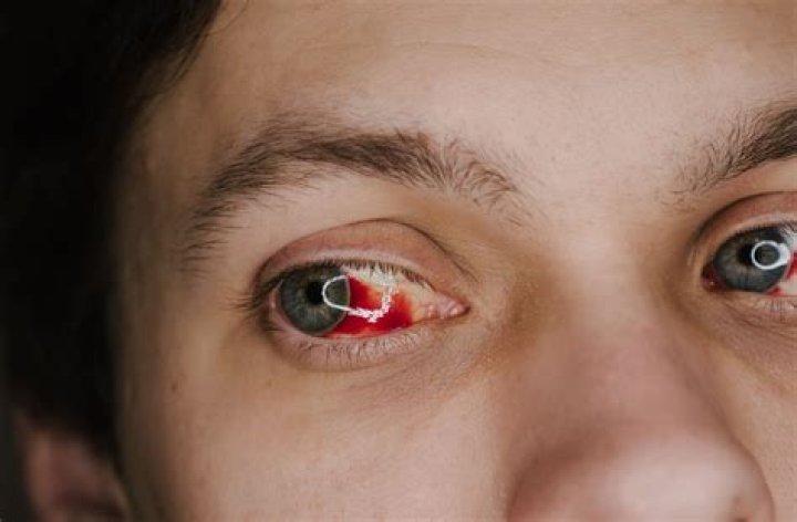 Did Anthony Joshua suffer a broken eye socket?