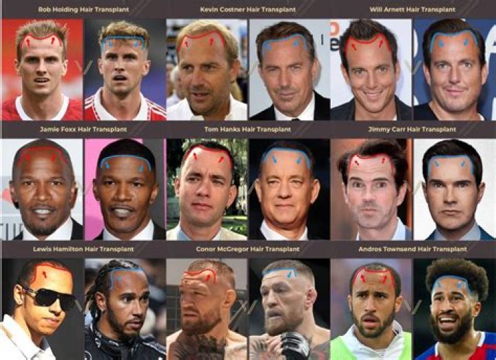 Did Judd Trump Had A Hair Transplant? Before And After Photos Of The Snooker Player