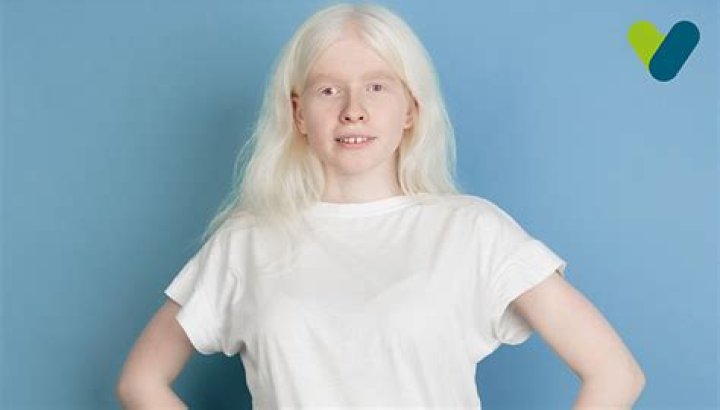 Does Aurora Aksnes have autism? Does Aurora Aksnes have albinism?