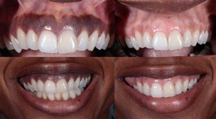 How to get rid of dark gums