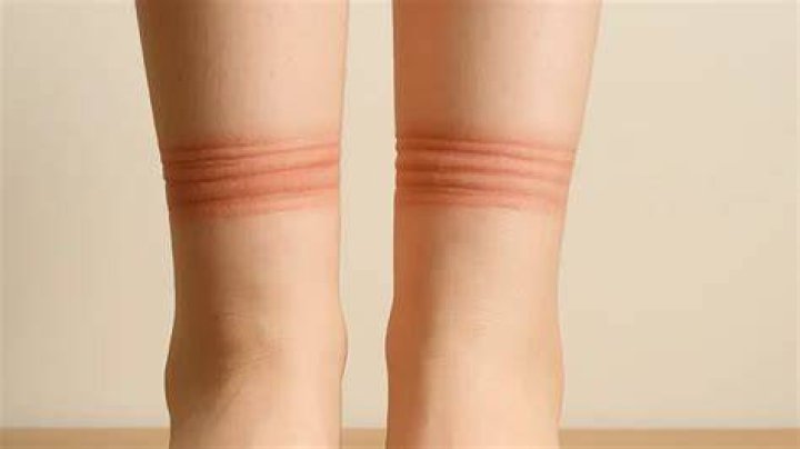 Is it normal for my socks to leave marks