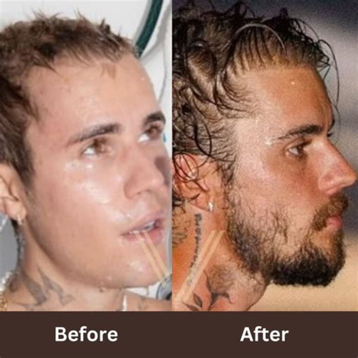 Justin Bieber Seeks Treatment After Struggling With Depression For A While!