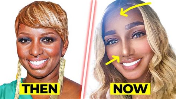 NeNe Leakes’ Fans Tell Her That She Looks Like Any Other ‘Surgery Star’