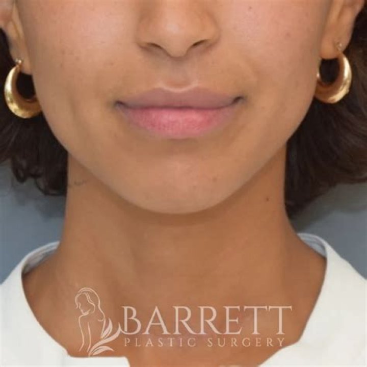Nessa Barrett Lip Surgery, Tattoo, Eating Disorder, Race