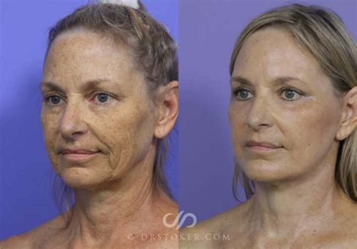 Sally Field Facelift Plastic Surgery Before and After