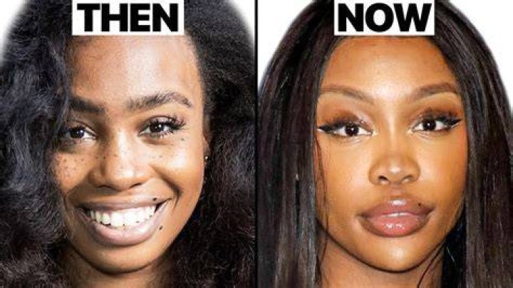 Skai Jackson Surgery Update: What Happened To Her Nose?