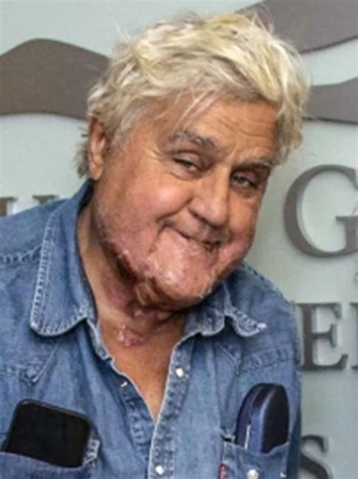 What disorder does Jay Leno have? – Celebrity