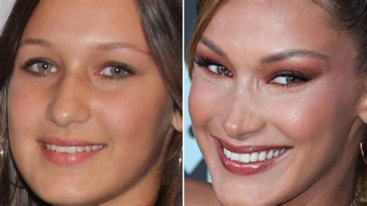 What type of plastic surgery did Bella Hadid have?